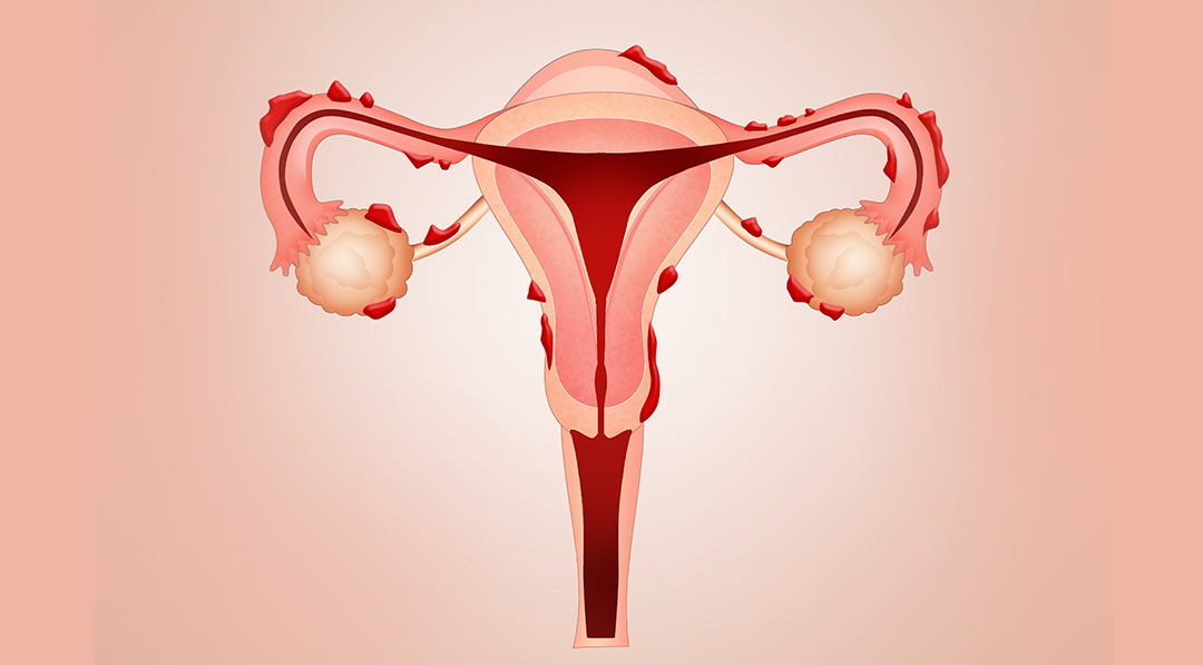 Endometriose o que é e como tratar?
